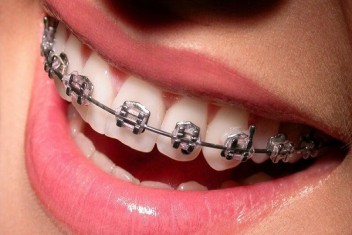 لبخند با ارتودنسی دندان