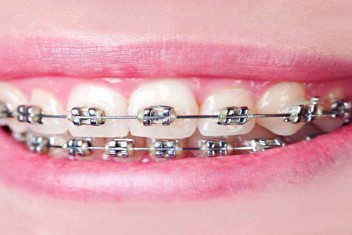 مزایای ارتودنسی ثابت دندان