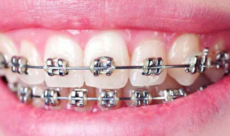 مزایای ارتودنسی ثابت دندان