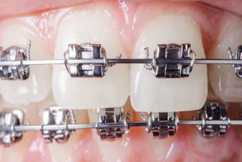 مزیت استفاده از ارتودنسی دیمون دندان 