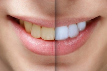 ارزان ترین مطب برای سفید کردن دندان (بلیچینگ)