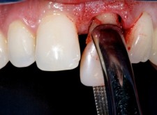 دلایل جراحی دندان 