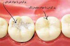 زمان و چگونگی پرکردن دندان 