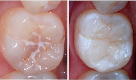 سیلانت یا درزگیر دندان