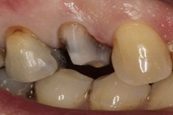 علت افتادن روکش دندان 