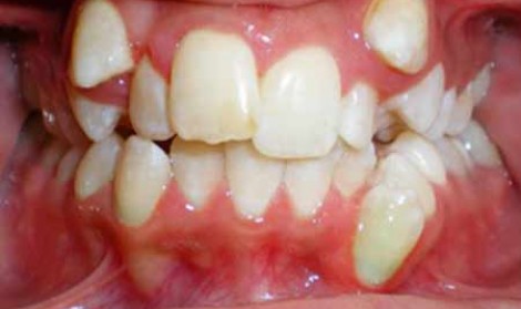 مزیودنس یا دندان اضافی