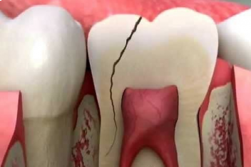 شکستگی ریشه دندان