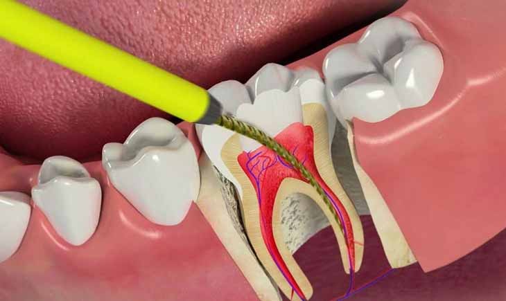 عصب کشی دندان چه زمان و چگونه انجام می شود؟