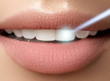  کاربرد لیزر در دندانپزشکی