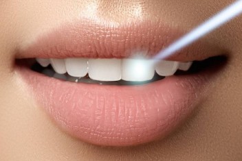  کاربرد لیزر در دندانپزشکی