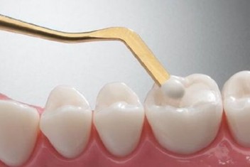 نانو کامپوزیت دندان 