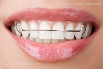 انواع ارتودنسی متحرک دندان