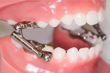 دستگاه فانکشنال دندان