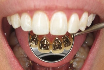 معایب ارتودنسی لینگوال دندان
