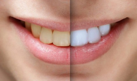 هزینه سفید کردن دندان (بلیچینگ)