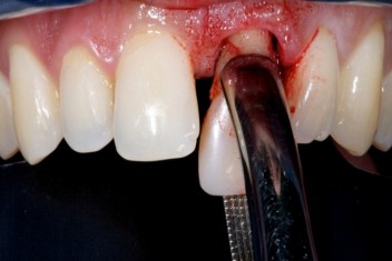 دلایل جراحی دندان 