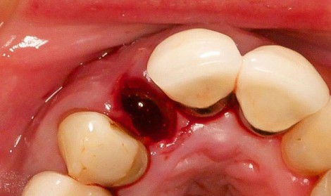درمان حفره خشک دندان