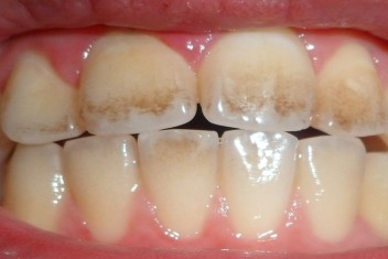 میناکاری دندان