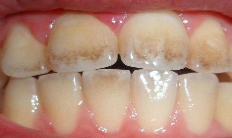 میناکاری دندان
