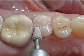 بیلداپ یا بازسازی دندان 