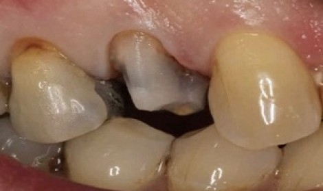 علت افتادن روکش دندان 