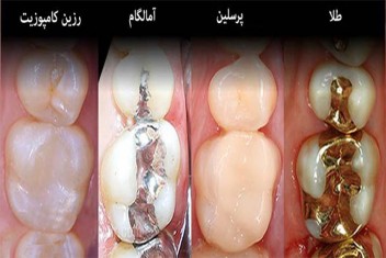 پر کردن دندان با مواد