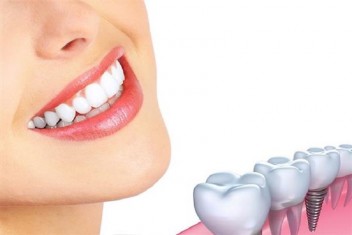 نکات مهم درباره ایمپلنت و کاشت دندان