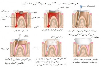 مراحل عصب کشی دندان‌