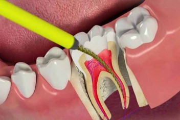 بهترین زمان برای عصب کشی دندان چه زمانی است؟