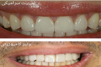 تفاوت کامپوزیت و لمینت دندان چیست 