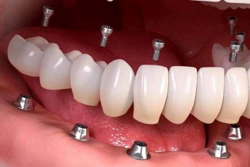 زیبایی با ایمپلنت دندان 